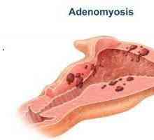 Materice adenomioza - što je to? maternice adenomioza: tretman narodnih pravnih lijekova, recenzije