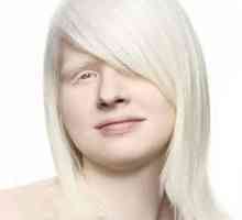 Albino - a ... Albinizam - kongenitalna odsustvo pigmenta melanina