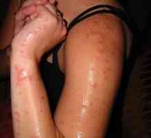 Alergičan na ujeda komaraca - Simptomi i tretman