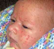 Alergija u novorođenčadi nije razlog za očaj
