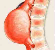 Aneurizme abdominalne aorte: uzroci, simptomi i liječenje