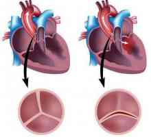 Aortne valvule je bikuspidnu: uzroci, simptomi, liječenje