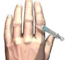 Artritis prstiju: liječenje, uzroci, simptomi