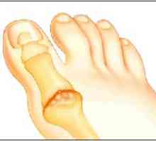 Artritisa stopala: vrsta, prevencija