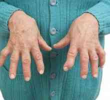 Osteoartritisa prste: Simptomi i tretman