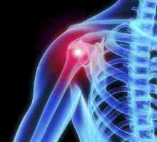 Osteoartritisa ramenog zgloba: Simptomi i tretman narodnih pravnih lijekova, uzrocima i metodama…