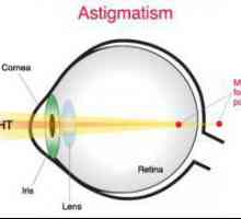 Astigmatic kontaktne leće: funkcija, vrste i upotreba tehnologije
