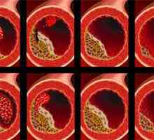 Arterioskleroze - Simptomi, uzroci i tretman
