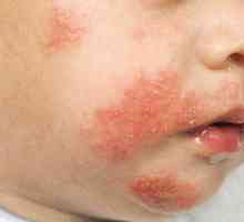 Atopijski dermatitis je dijete: uzroci, simptomi, liječenje