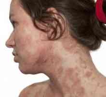 Atopije - atopijskog dermatitisa je ...