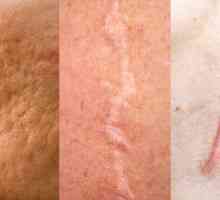 Atrofični ožiljci: uzroci tretmana
