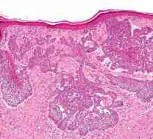 Bazalnih stanica raka kože: Simptomi, dijagnoza, tretman