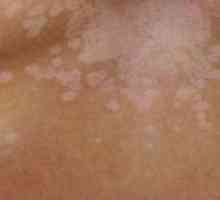 Bijele mrlje na koži nakon opekotina: liječenje, slika