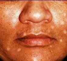 Bijele mrlje na licu može biti znak vitiligo