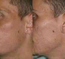Bezbolan i efikasan laser za uklanjanje ožiljaka