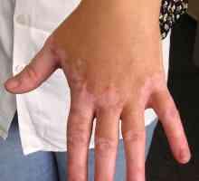 Vitiligo bolesti: Uzroci, Simptomi i metode tretiranja