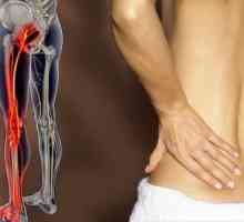 Bol u leđima zrači na noge: Uzroci, Liječenje