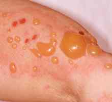 Bulozne dermatitis: uzroci, simptomi, dijagnoza i liječenje