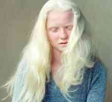Man albino. Ljudi "bez kožice"