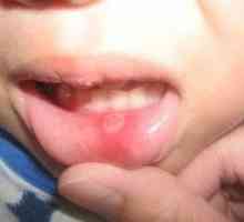 Poslasticu stomatitis kod djece i odraslih?