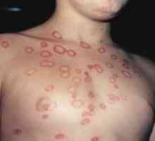 Koja je razlika mikrosporiya glatku kožu?
