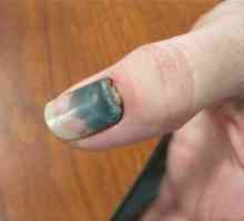 Crni nokti: Uzroci, Liječenje