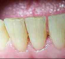 Šta ako je bilo pukotine u zubima? Uzroci i tretman