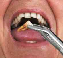 Šta da radim nakon vađenja zuba - kako zaustaviti krvarenje i izliječiti rane