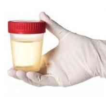 Šta analizu urina na Nechiporenko? Dešifriranje urin Nechiporenko. Kako proći urina Nechiporenko