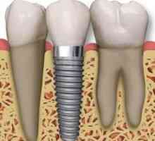 Da stomatolozi preporučuju, kada postoji potreba da ubacite zube?
