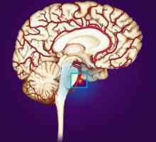 Ono što je moždane aneurizme? Moždane aneurizme: Simptomi, Dijagnoza