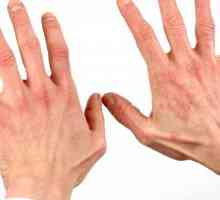 Što je dermatitis? Kako izliječiti dermatitis?