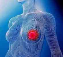 Koja je dojke, uzroci, simptomi i tretman