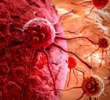 Što je metastatski karcinom? Malignih tumora i metastaza