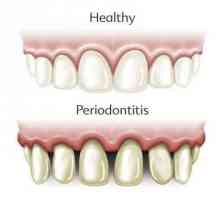 Što je parodontitis? Klasifikacija i tretman