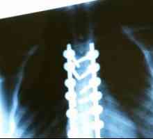 Ono što je X-ray kralježnice?