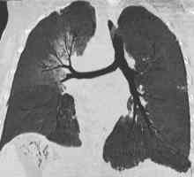 Ono što je Kaposijev pluća? Mogu li riješi to?