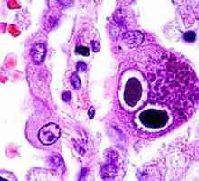 Citomegalovirus infekcija: simptomi kod žena. Uzroci i tretmani za CMV infekcije
