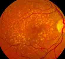 Makularne degeneracije retine: Simptomi i tretman