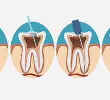 Korijena zuba kanala: ima tretmana, indikacije