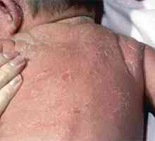 Eksfolijativni dermatitis kod odraslih i novorođenčadi (foto)