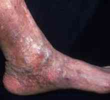 Dermatitis na nogama