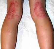 Dermatitis na nogama: uzroci i tretman