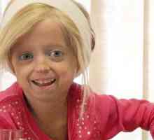 Djeca Progerija: Da li ima decu šanse?