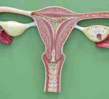 Dijagnozu "endometrioze": simptomi i liječenje bolesti