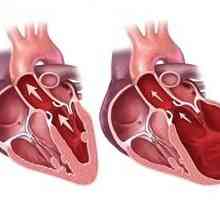 Dijastolna disfunkcija lijeve klijetke srca. Opis. tretman
