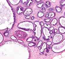 Difuzna fibroadenomatosis mliječne žlijezde: uzroci i tretman