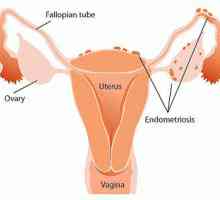 "Djufaston" Endometrioza - preporuke. Efikasnosti "Duphaston" cijenu