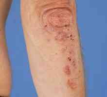 Duhring dermatitis: uzroci, simptomi, dijagnoza i mogućnosti liječenja