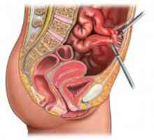 Ono što se vrši laparoskopiju jajnika?